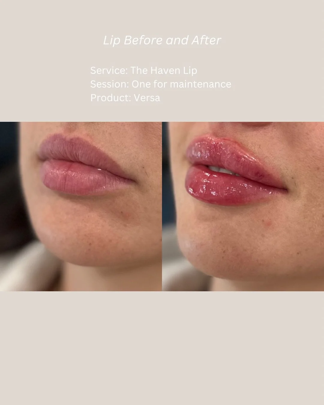 Fuller. Sharper. Still completely her. 

This is what the right amount of filler in the right hands actually looks like. Volume where it was missing. Definition where it had softened. A cupid&rsquo;s bow that shows up the way it&rsquo;s supposed to.
