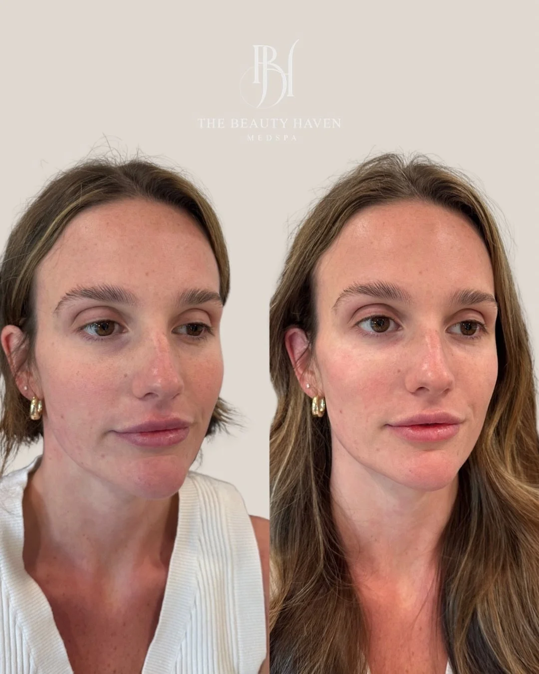Our very own Sydney in the chair! 

EZ Gel is platelet rich fibrin harvested from your own blood and placed precisely in the tear trough to restore volume, brighten hollowing, and stimulate the tissue from within. 

No synthetic filler in one of the 