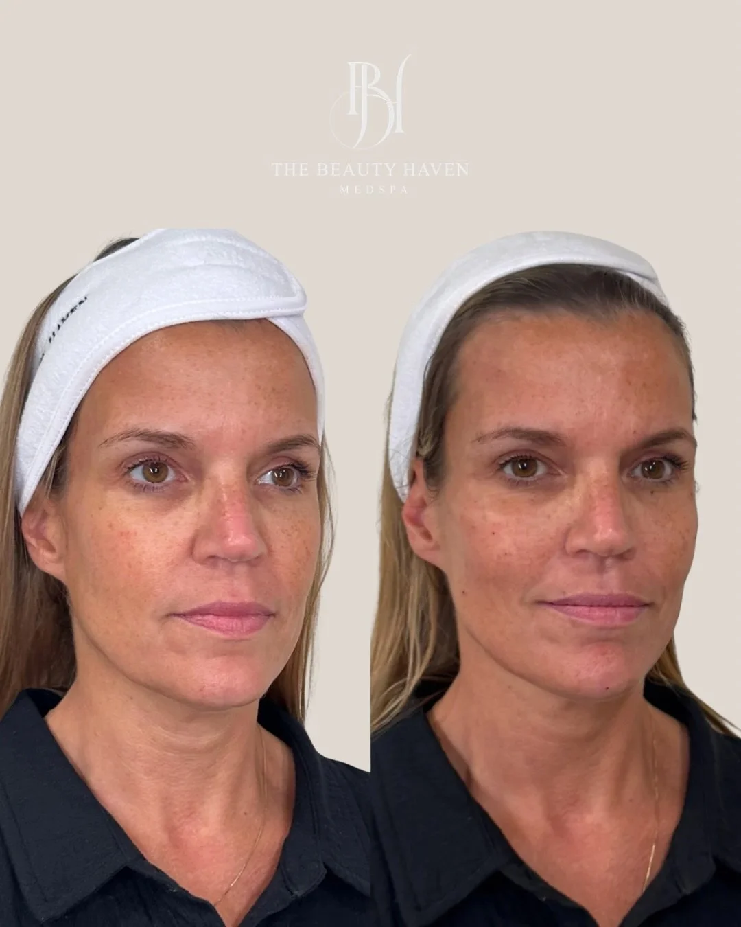 The upper face creates structure and when it&rsquo;s supported properly everything below it follows. 💉

Temples and cheeks. Two areas most people don&rsquo;t think about until they really look and then they can&rsquo;t unsee what was missing.

Templ
