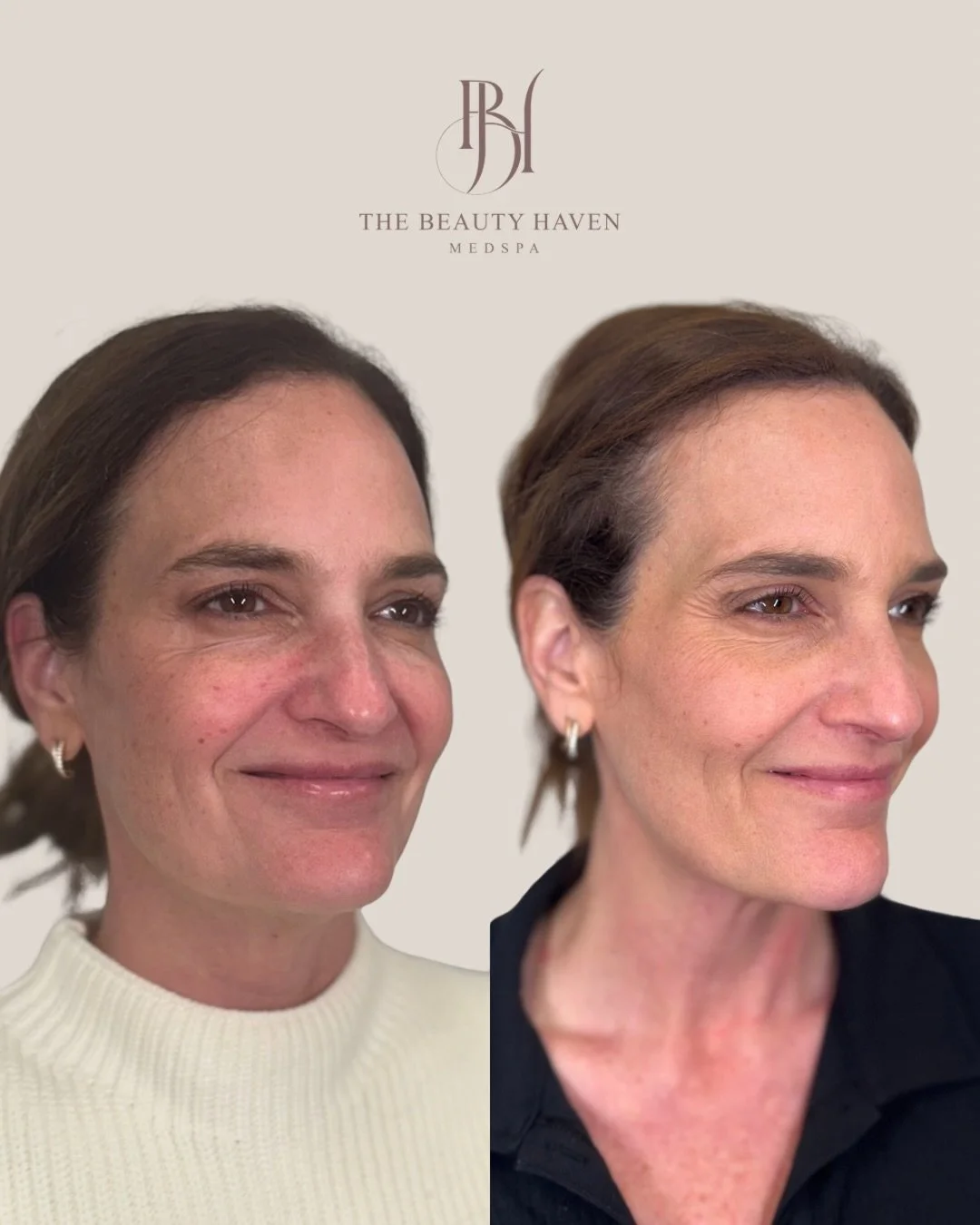 One session. Two treatments. 

Microneedling and LaseMD Ultra in the same appointment and the results speak for themselves.

SkinPen microneedling creates controlled micro-channels in the skin that trigger your body&rsquo;s own collagen and elastin p