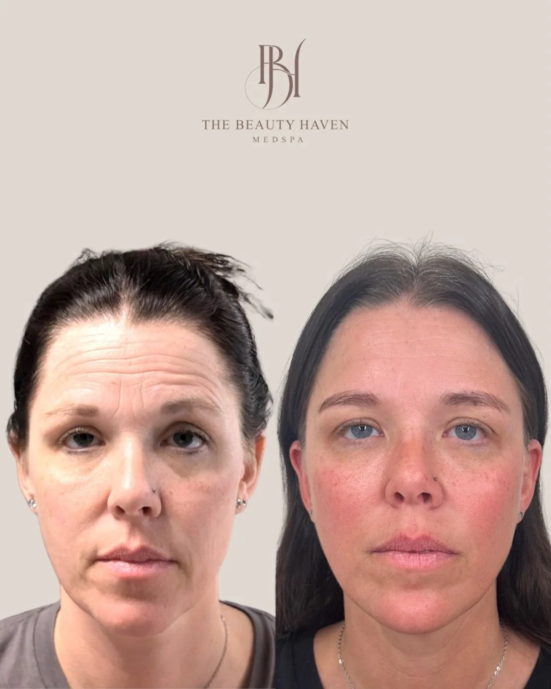 Four weeks later when everything settled in vs. fresh off the needle. 

The first three images are the real result. Filler fully healed and tox completely set in and this is what we were working toward the entire time.

The last few images are immedi