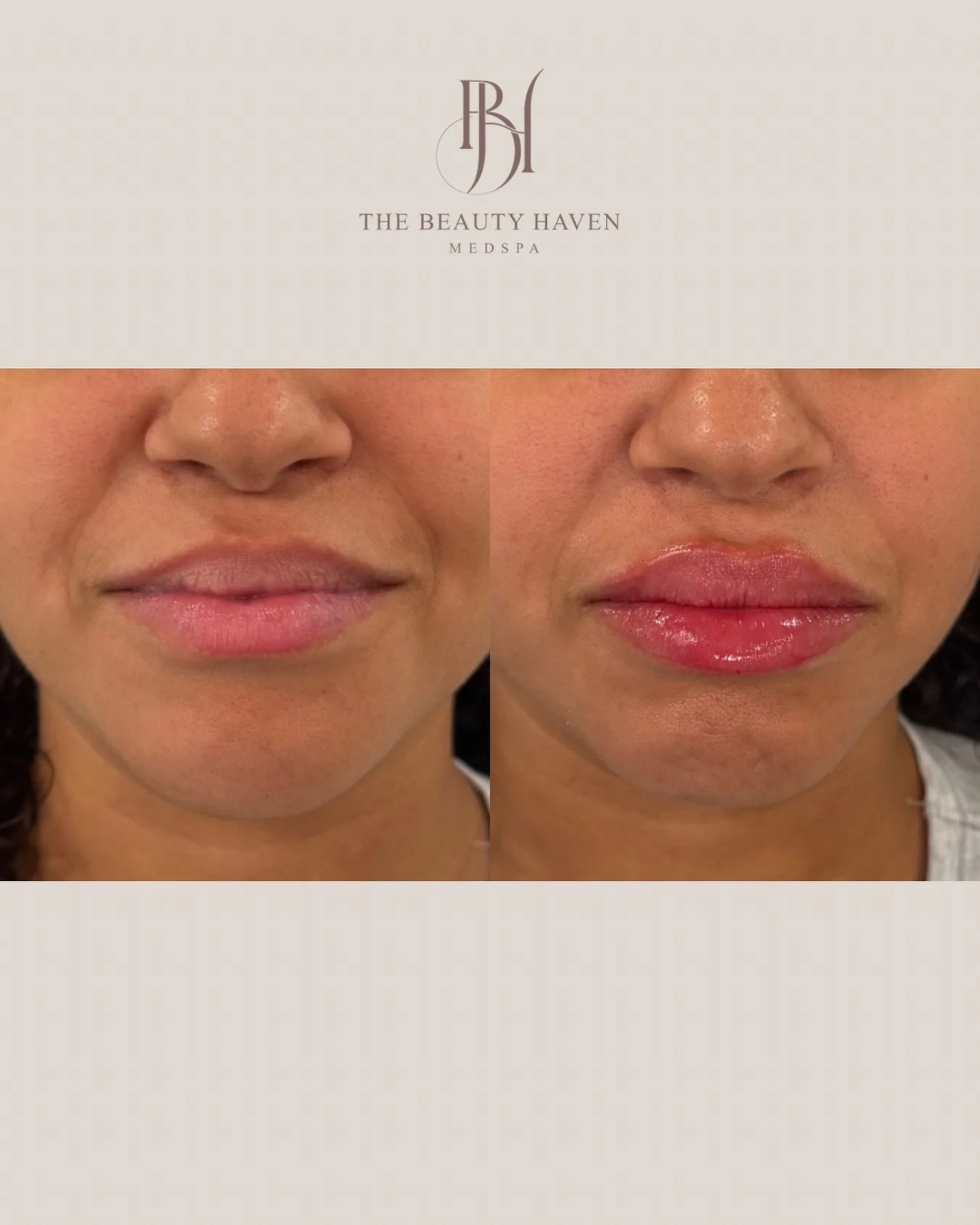 Sydney&rsquo;s lip work👄🥰😍

Fuller. More defined. Still completely natural, because that is the only way we do it here.

This is what happens when the right amount of product meets the right pair of hands. Volume restored exactly where it was need