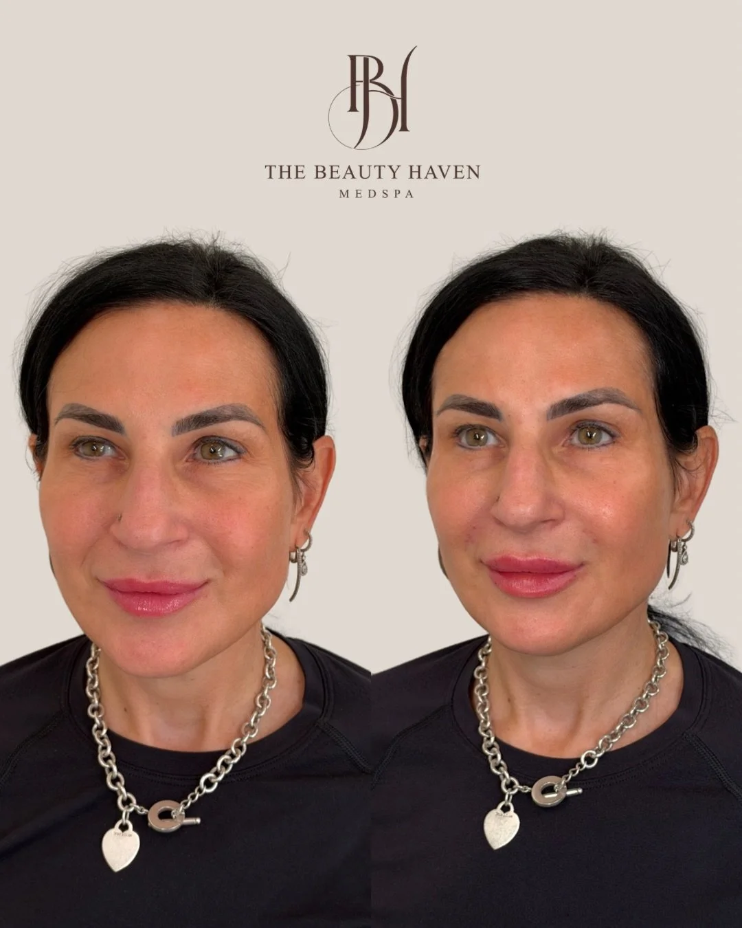 Are your brows starting to drop? Noticing a bony prominent rim near your eyebrow? Feeling like your face is just... falling? 👀

You may need temple filler. And this result is exactly why.

The temples are one of the most overlooked areas in aestheti