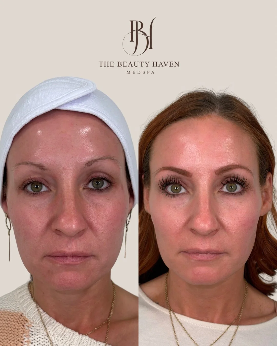 Before photos - preconditioning, a single peel, and the right skincare regimen was in place. After photos - results from just one peel with Sara. 🤍

This is what happens when you stop guessing and start with a plan.

The first image is where we star