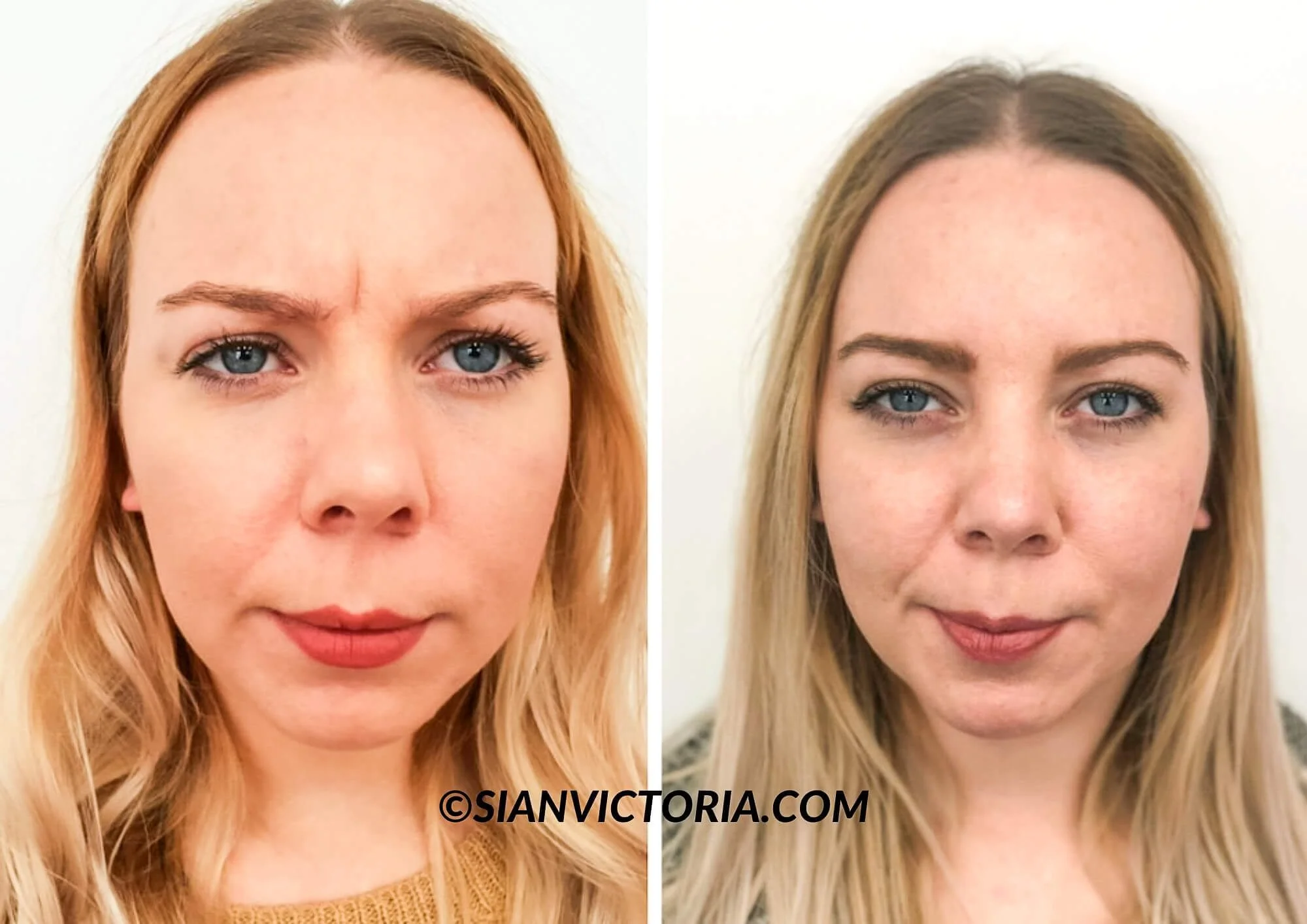 Before & After: Forehead Botox Treatment in Birmingham — sian victoria