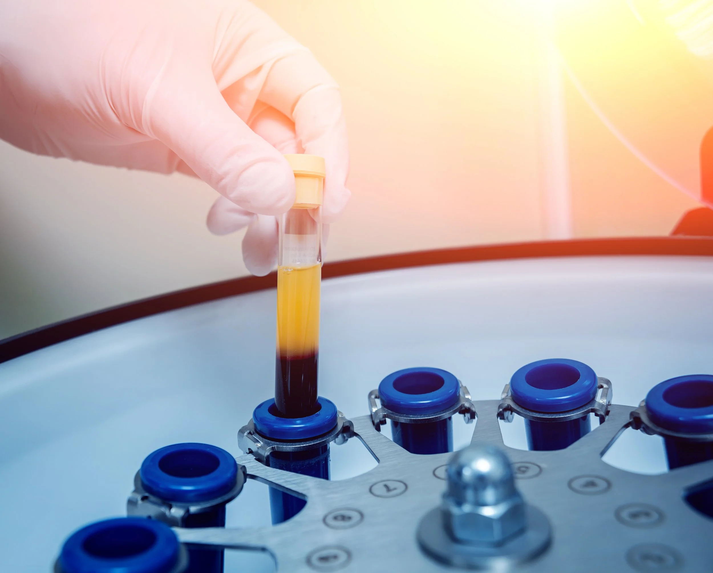 Episode 182: Overtime – Can Exercise Improve PRP? Exploring Exercise-Mobilized Platelet-Rich Plasma