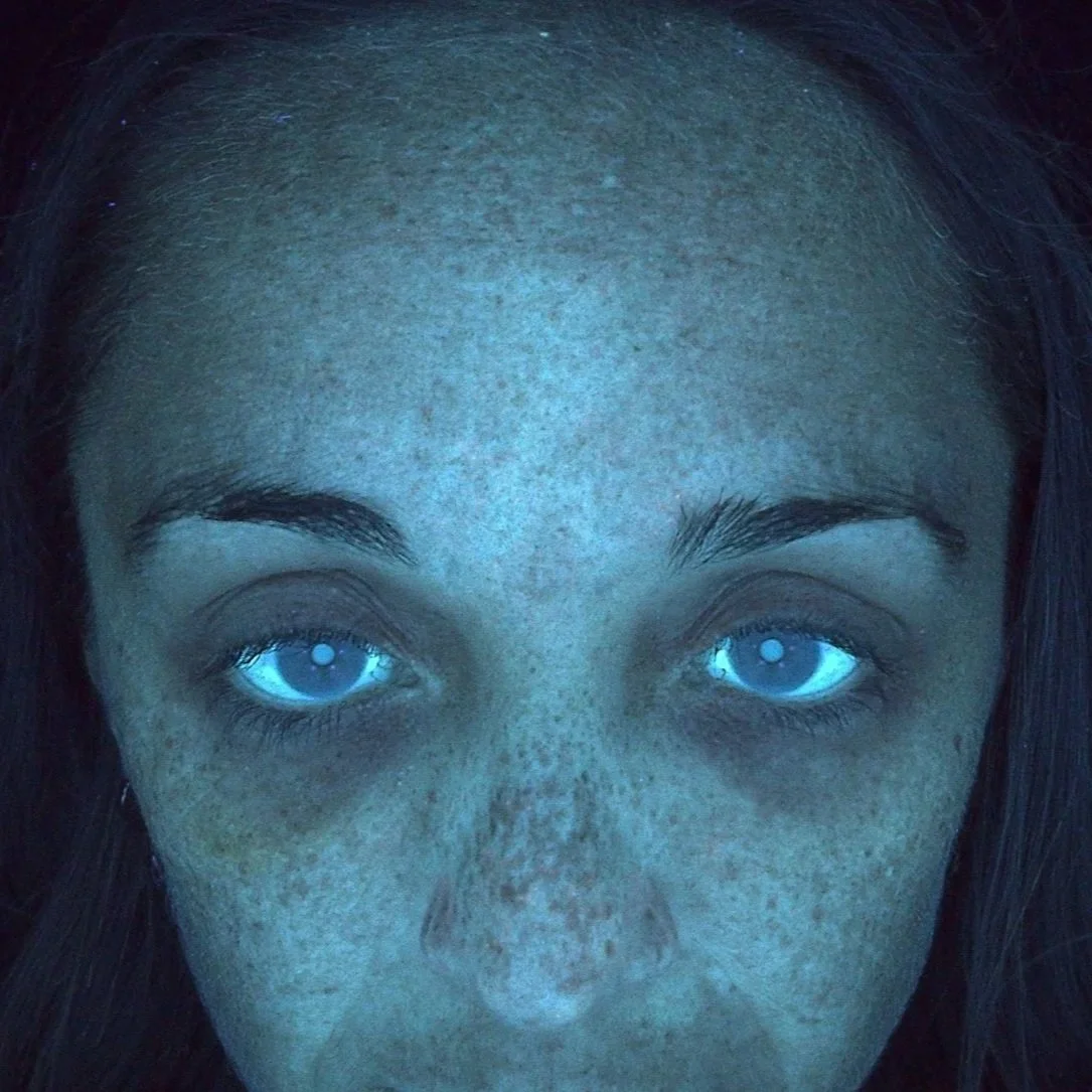 Plate-rich plasma (PRP) - skin treatment - cosmetic clinic - pigmentation reduction - UV damage - sun damage - dark under eyes