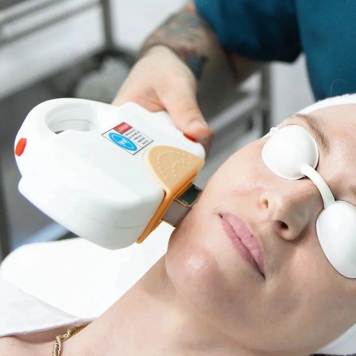 IPL - vascular therapy - broken capillaries - spider veins - cherry angiomas - redness - facial flushing - rosacea - red face - skin treatment - skin clinic - cosmetic clinic - geraldton - pure cosmetics