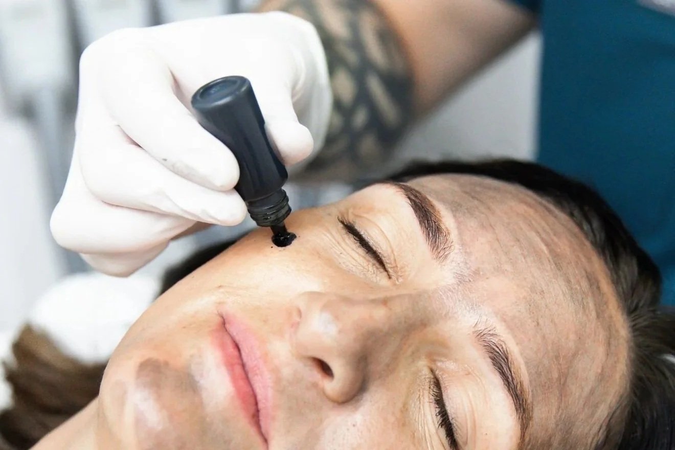 carbon laser peel - hollywood facial - china doll facial - redness - facial flushing - rosacea - red face - skin treatment - skin clinic - cosmetic clinic - geraldton - pure cosmetics