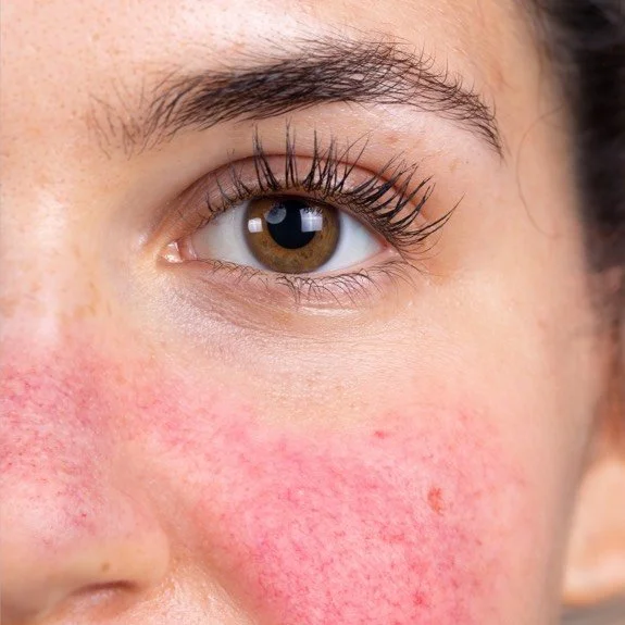 redness - facial flushing - rosacea - red face - skin treatment - skin clinic - cosmetic clinic - geraldton - pure cosmetics