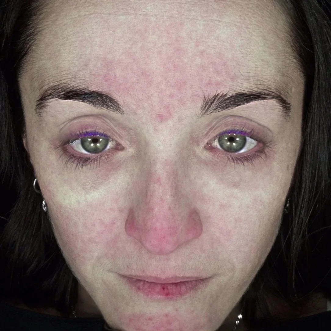 Plate-rich plasma (PRP) - skin treatment - cosmetic clinic - pigmentation reduction - uneven skin tone and complexion - redness