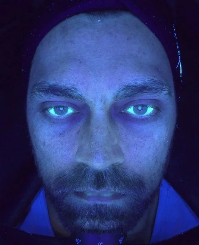 carbon laser facial - geraldton cosmetic clinic - oil - congestion - acne - clogged pores - exfoliation - hydrated skin