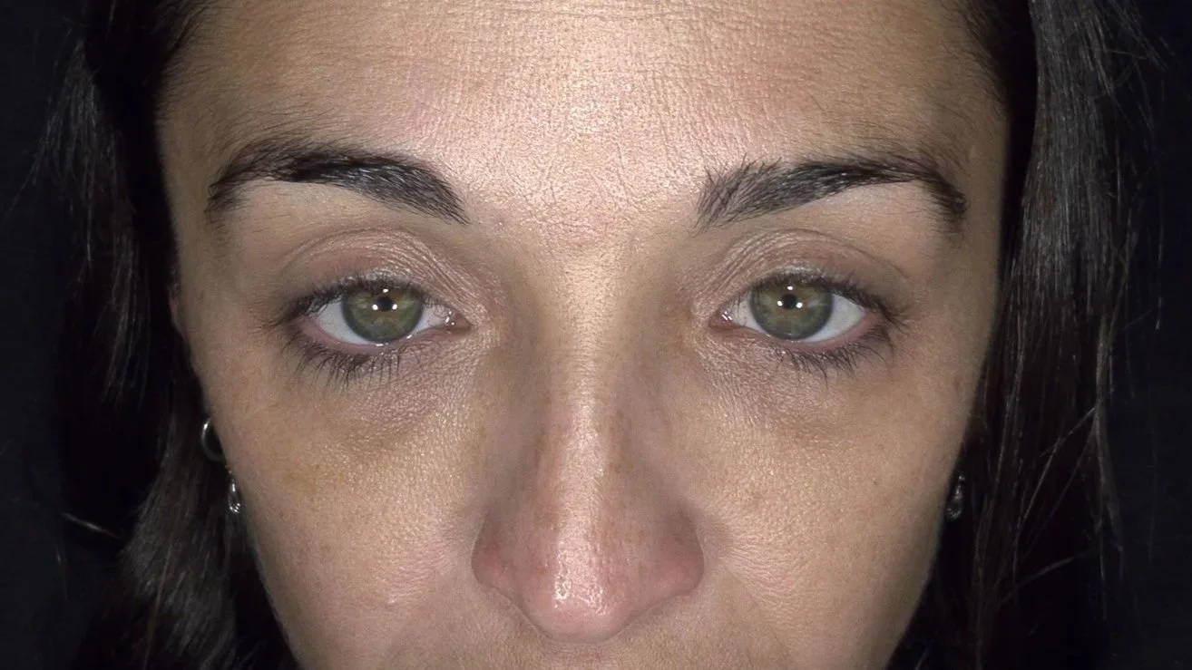 Geraldton cosmetic and skin clinic - Dark under eyes - crows feet - skin treatment - rejuvenation - Platelet-rich plasma - PRP - crows feet - puffy eyes = under eye bags - geraldton