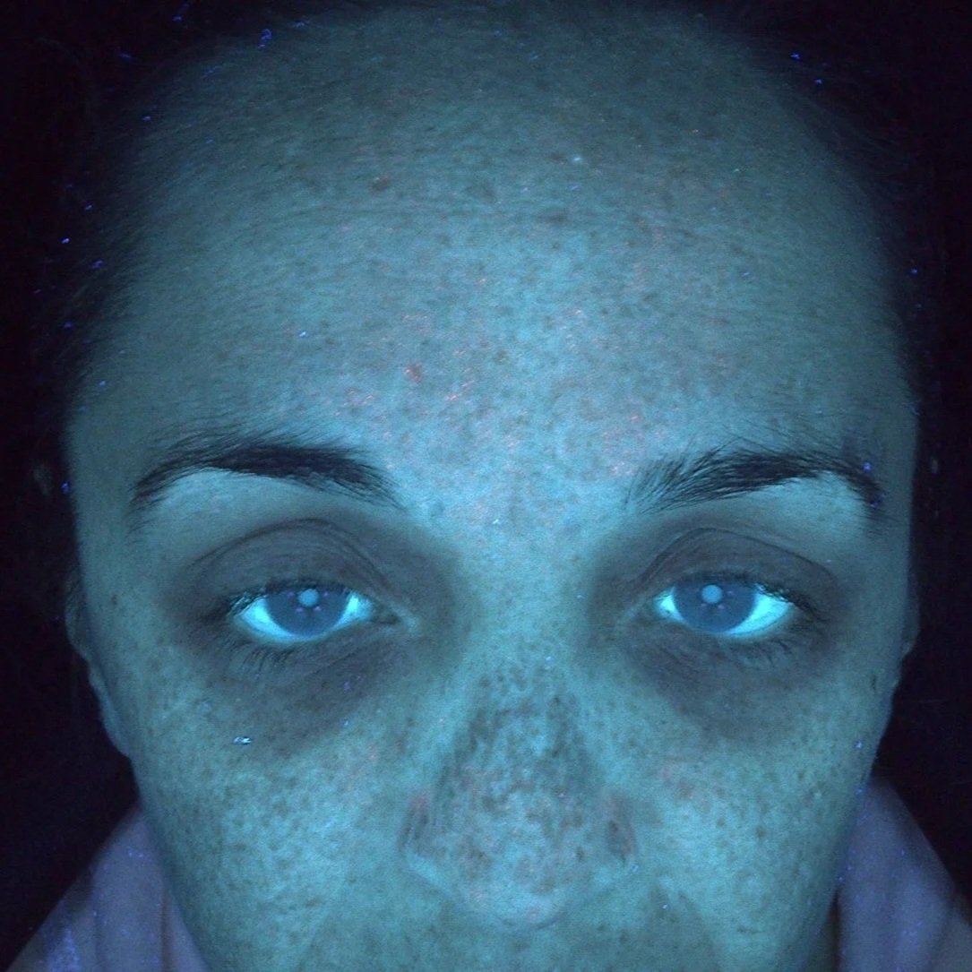 Plate-rich plasma (PRP) - skin treatment - cosmetic clinic - pigmentation reduction - UV damage - sun damage - dark under eyes