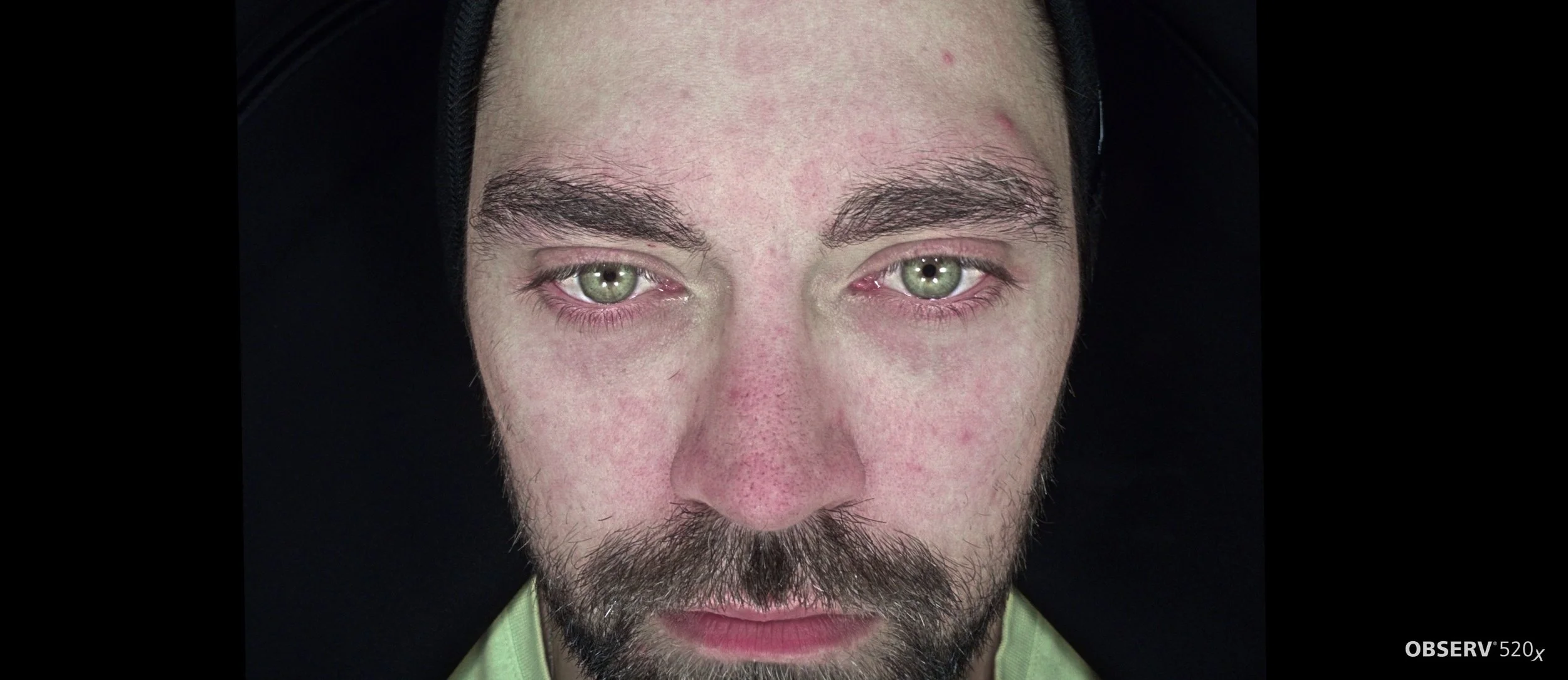 carbon laser facial - geraldton cosmetic clinic - oil - congestion - acne - clogged pores - exfoliation - hydrated skin - redness