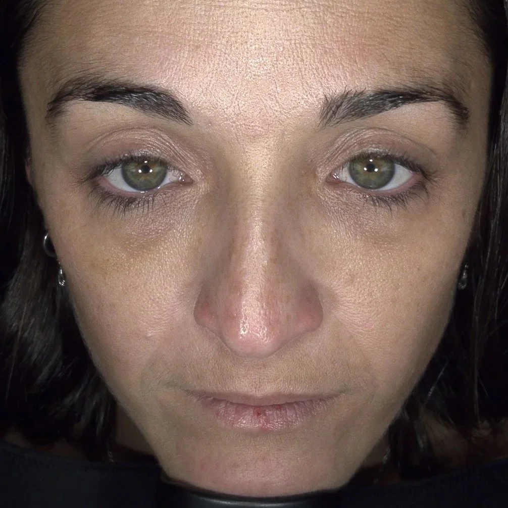 Plate-rich plasma (PRP) - skin treatment - cosmetic clinic - pigmentation reduction - uneven skin tone and complexion - dark under eyes