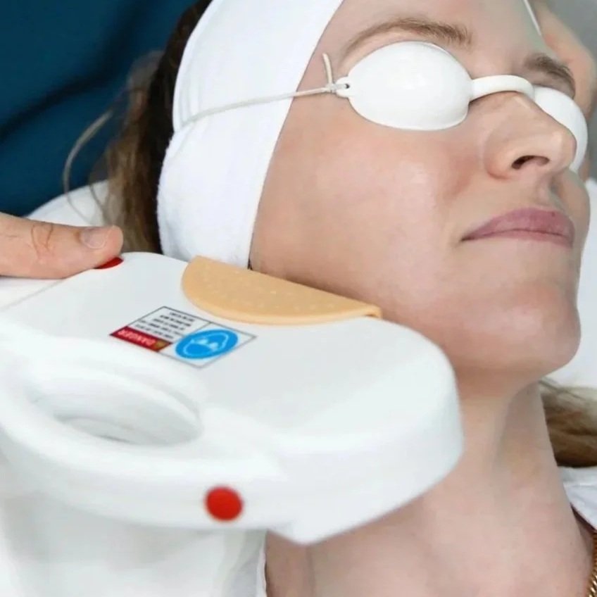 IPL - vascular therapy - facial flushing - rosacea - broken capillaries - spider veins - cherry angiomas - redness - facial flushing - rosacea - red face - skin treatment - skin clinic - cosmetic clinic - geraldton - pure cosmetics