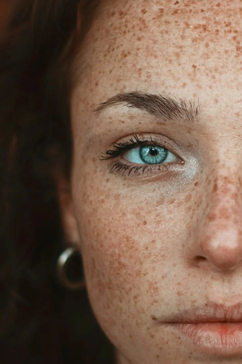 pigmentation correction - melasma - hyperpigmentation - pigmentation - freckles - sun spots - melasma - post inflammatory hyperpigmentation - skin treatments - skin clinic - cosmetic clinic - geraldton - pure cosmetics