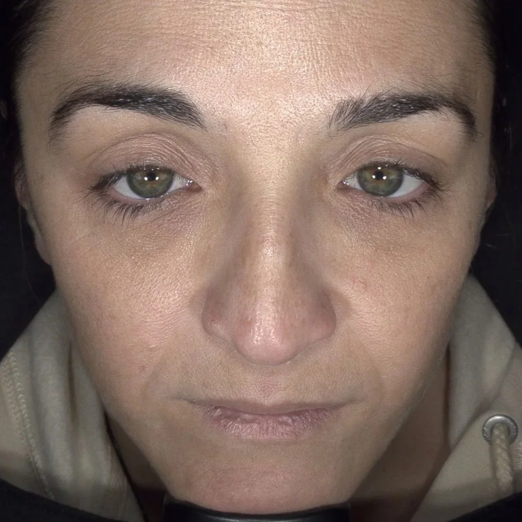 Plate-rich plasma (PRP) - skin treatment - cosmetic clinic - pigmentation reduction - uneven skin tone and complexion - dark under eyes