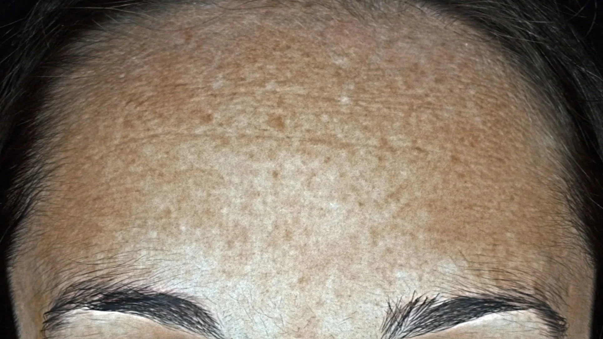 Plate-rich plasma (PRP) - skin treatment - cosmetic clinic - pigmentation reduction