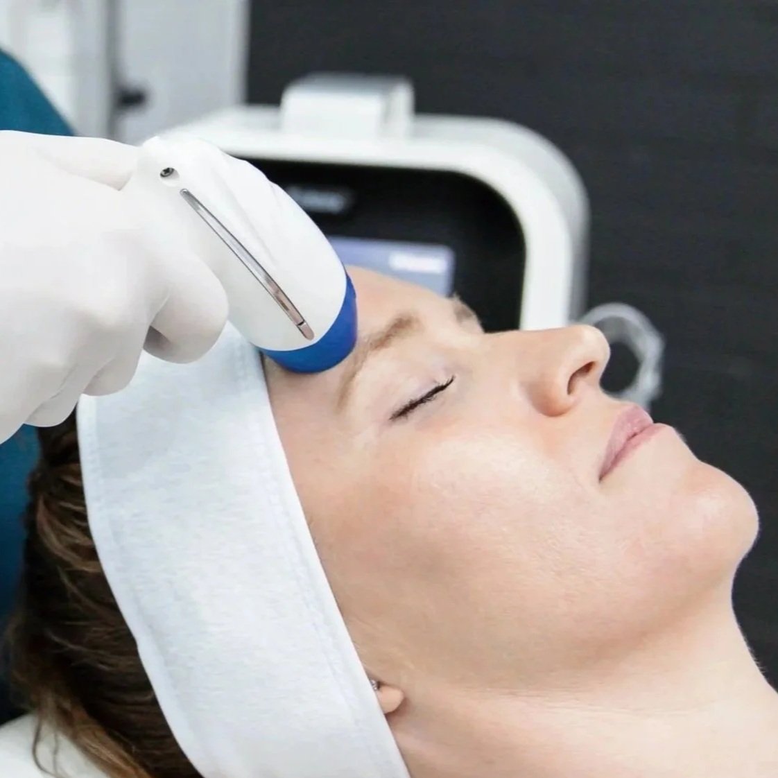 fractional radiofrequency skin resurfacing - skin treatment - acne treatments - acne - oily skin - clogged pores - acne scars - skin clinic - cosmetic clinic - geraldton - pure cosmetics