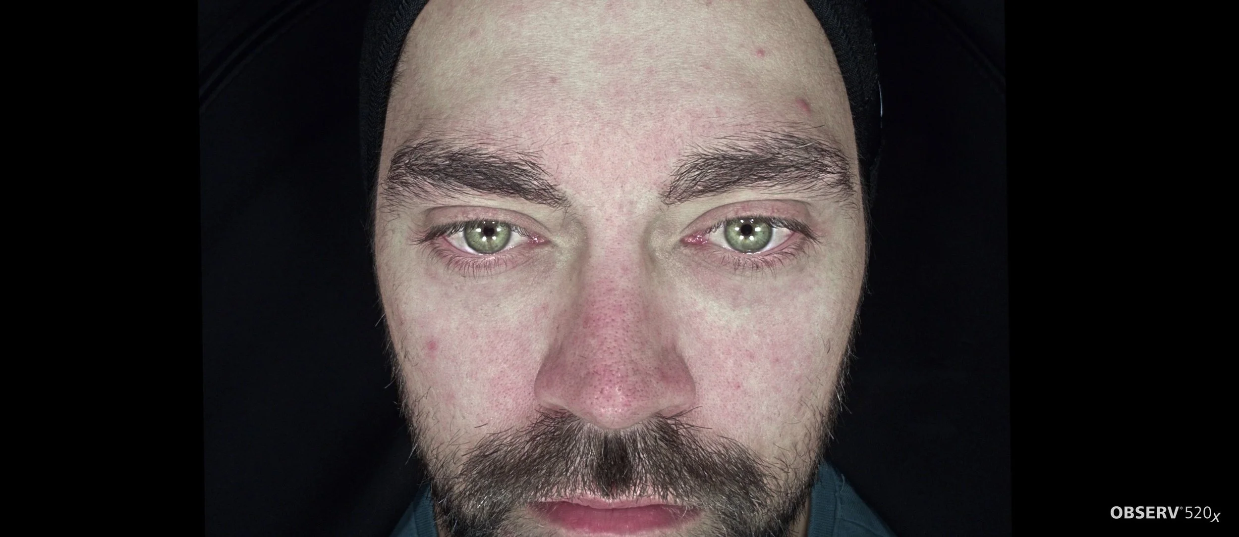 carbon laser facial - geraldton cosmetic clinic - oil - congestion - acne - clogged pores - exfoliation - hydrated skin - redness