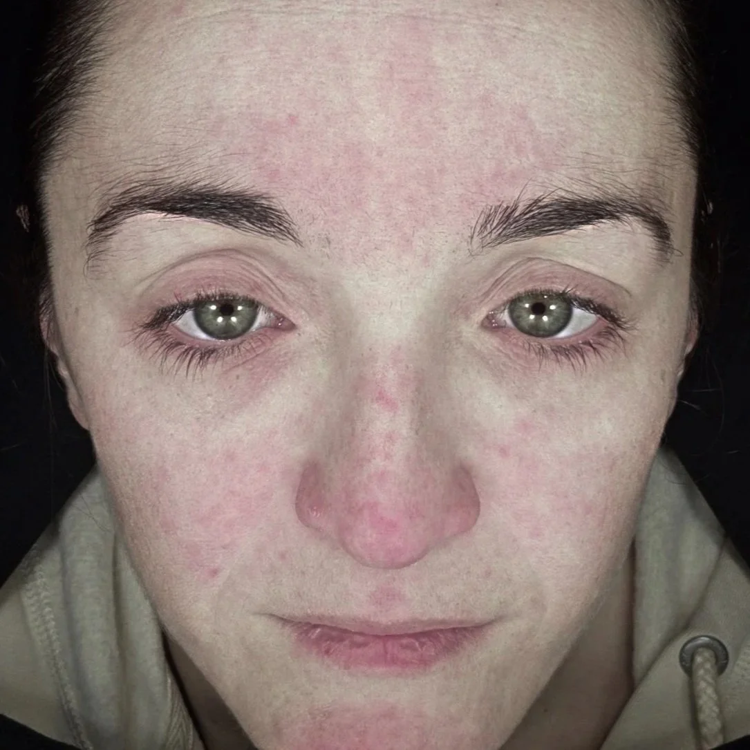 Plate-rich plasma (PRP) - skin treatment - cosmetic clinic - pigmentation reduction - uneven skin tone and complexion - redness