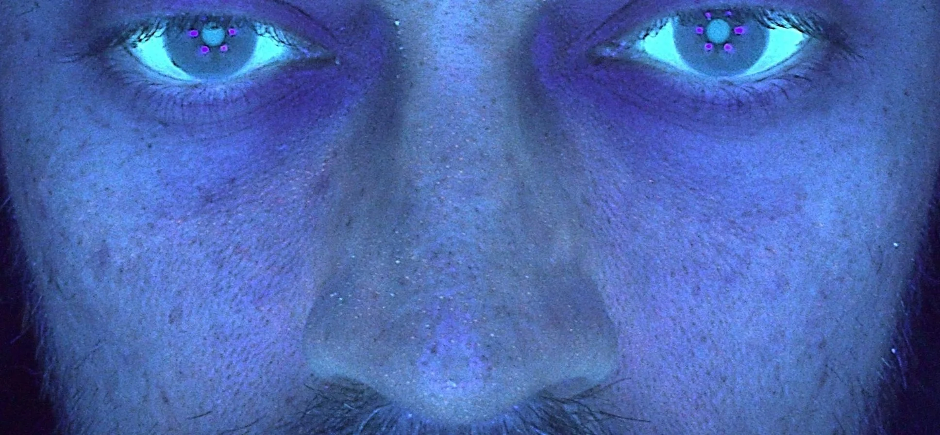 carbon laser facial - geraldton cosmetic clinic - oil - congestion - acne - clogged pores - exfoliation - hydrated skin