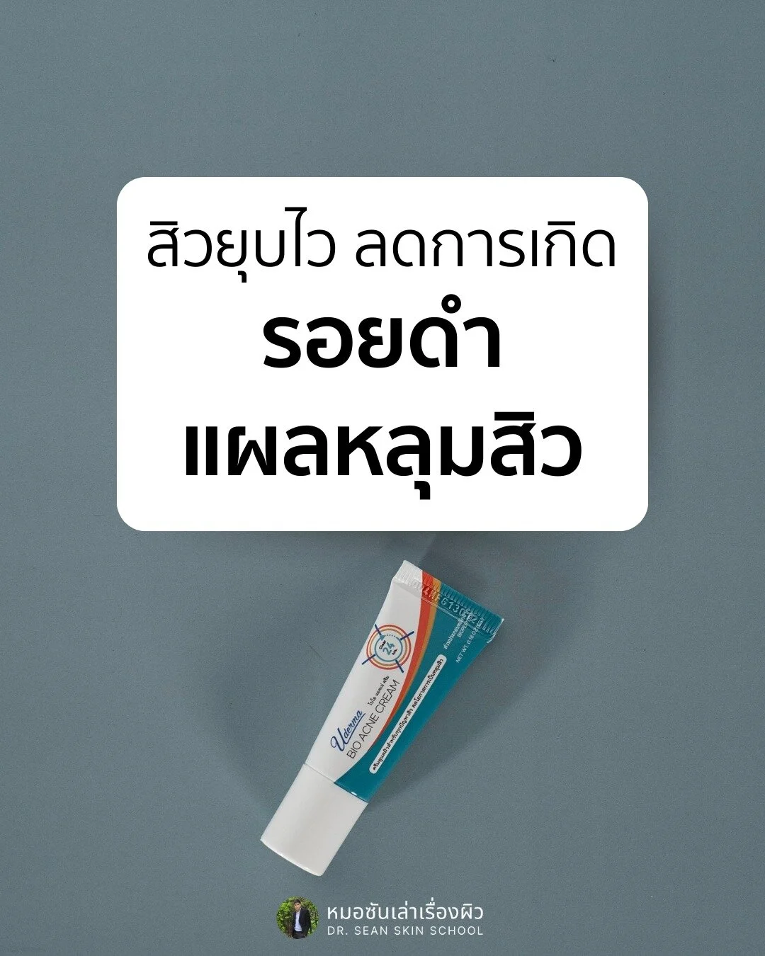 สิวยุบไว ลดการเกิดรอยดำ แผลหลุมสิว

ปัญหาตามมาหลังเป็นสิวที่ชวนปวดหัวสุดๆ คือ รอยดำจากสิวหลังการอักเสบ (Postinflammatory hyperpigmentation หรือ PIH) และแผลเป็นจากสิว (Acne scars) แต่อย่าเพิ่งกังวลไป โพสต์นี้ผมมีเคล็ดลับการดูแลผิวเพื่อลดปัญหานี้มาฝากท