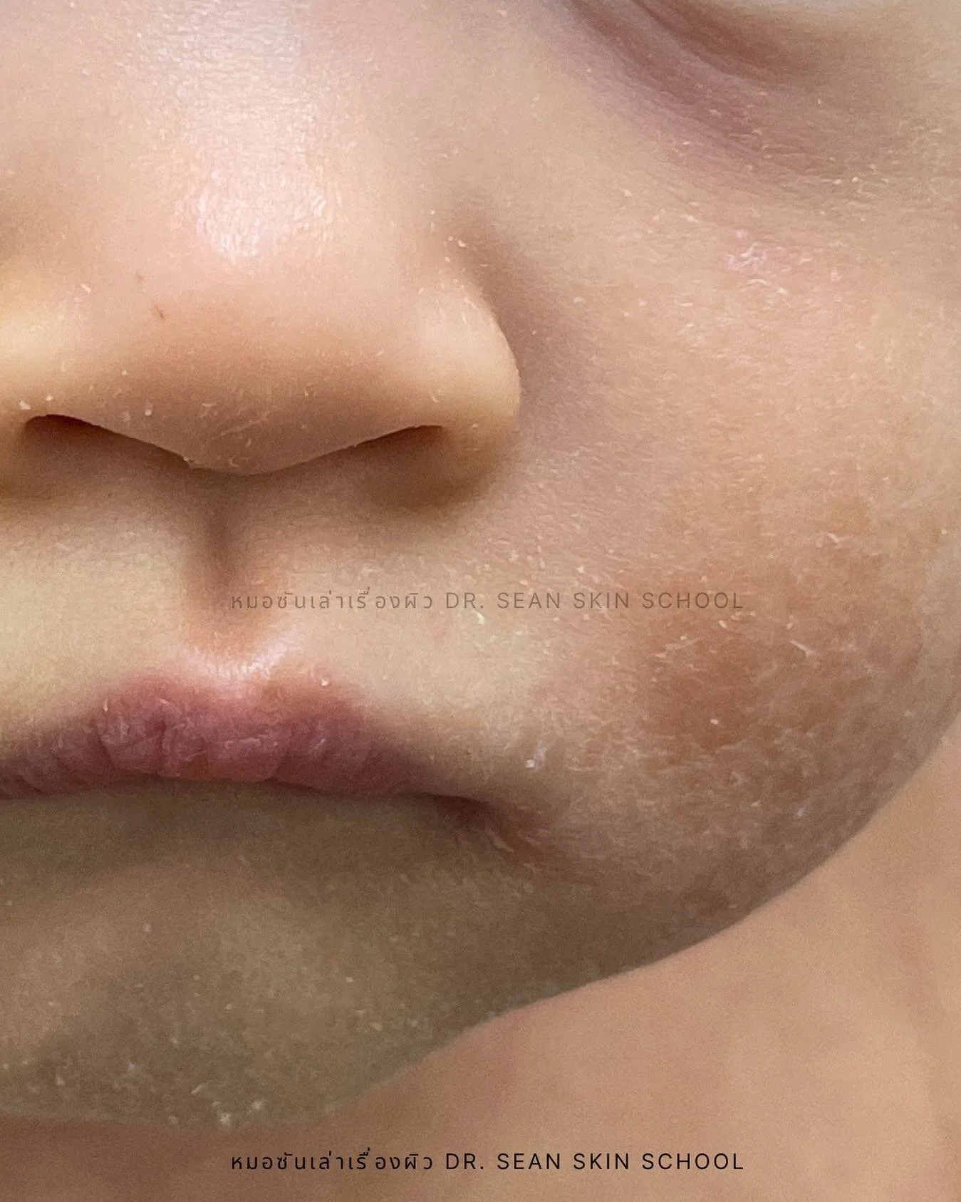 #ผิวชุ่มชื้นเท่านั้นที่น็อคเอฟวรี่ติง

โพสต์นี้ผมมีภาพจากคนไข้ที่ #ชั้นปราการผิวเสียหน้าที่ มาฝากครับ จะเห็นว่าผิวแห้งมากกก ลอก เป็นขุย แดงอักเสบ 🧱 น้องมีอาการคันด้วยครับ ซึ่งเป็นลักษณะสำคัญของภูมิแพ้ผิวหนัง (ผิวหนังอักเสบภูมิแพ้) หรือ Atopic dermat