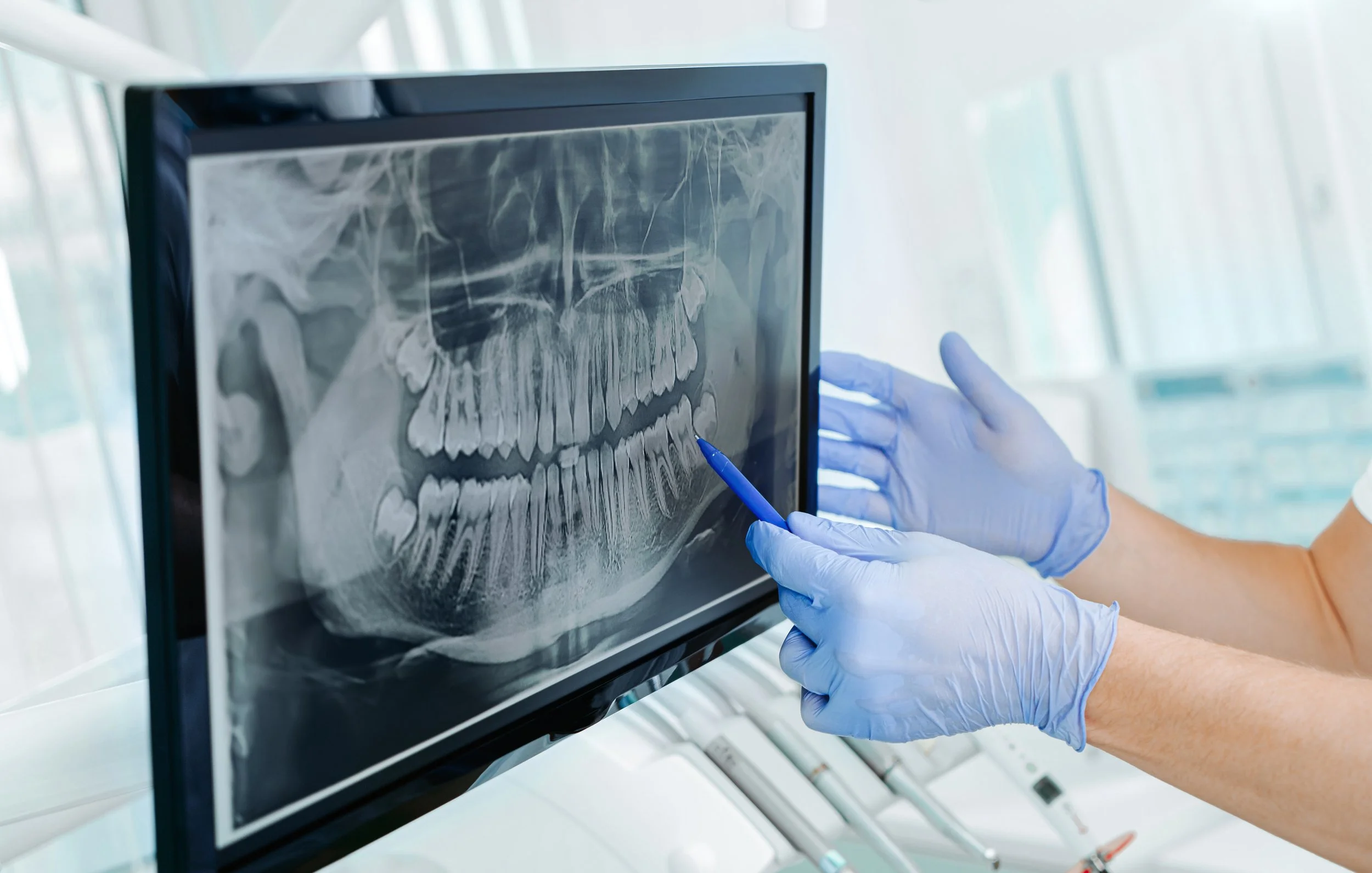 Root Canal Retreatment North County