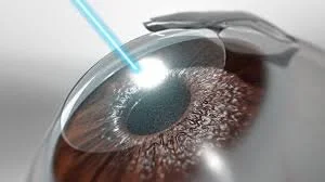 LASIK, une référence mondiale en chirurgie de la vision