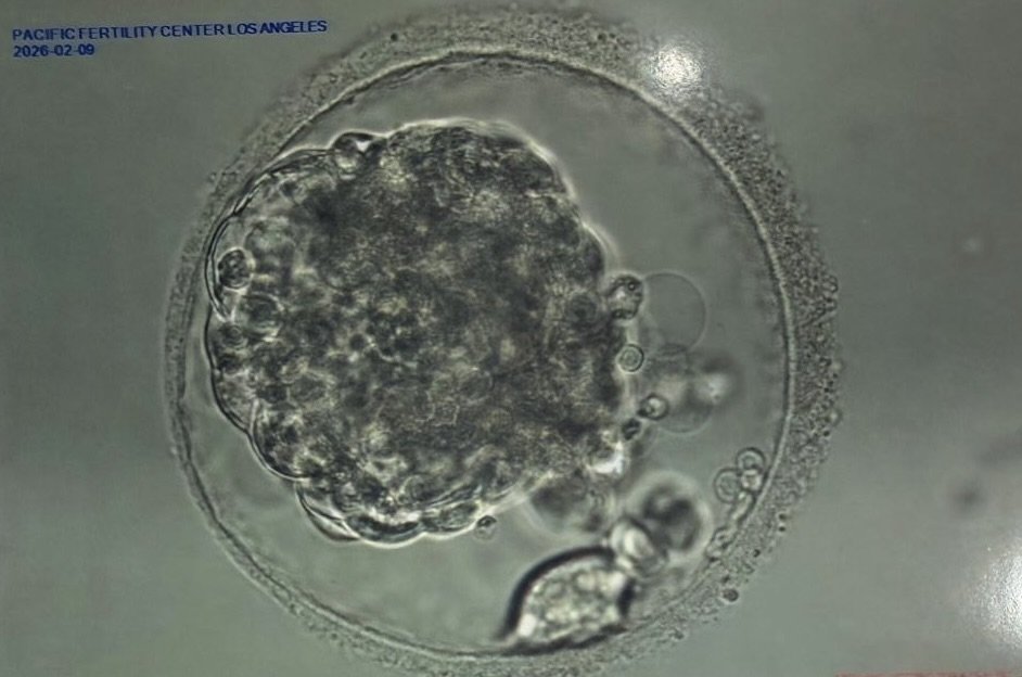 Diary of a Second Embryo Transfer