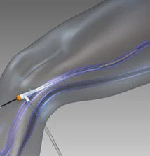 Radiofrequency ablation treatment