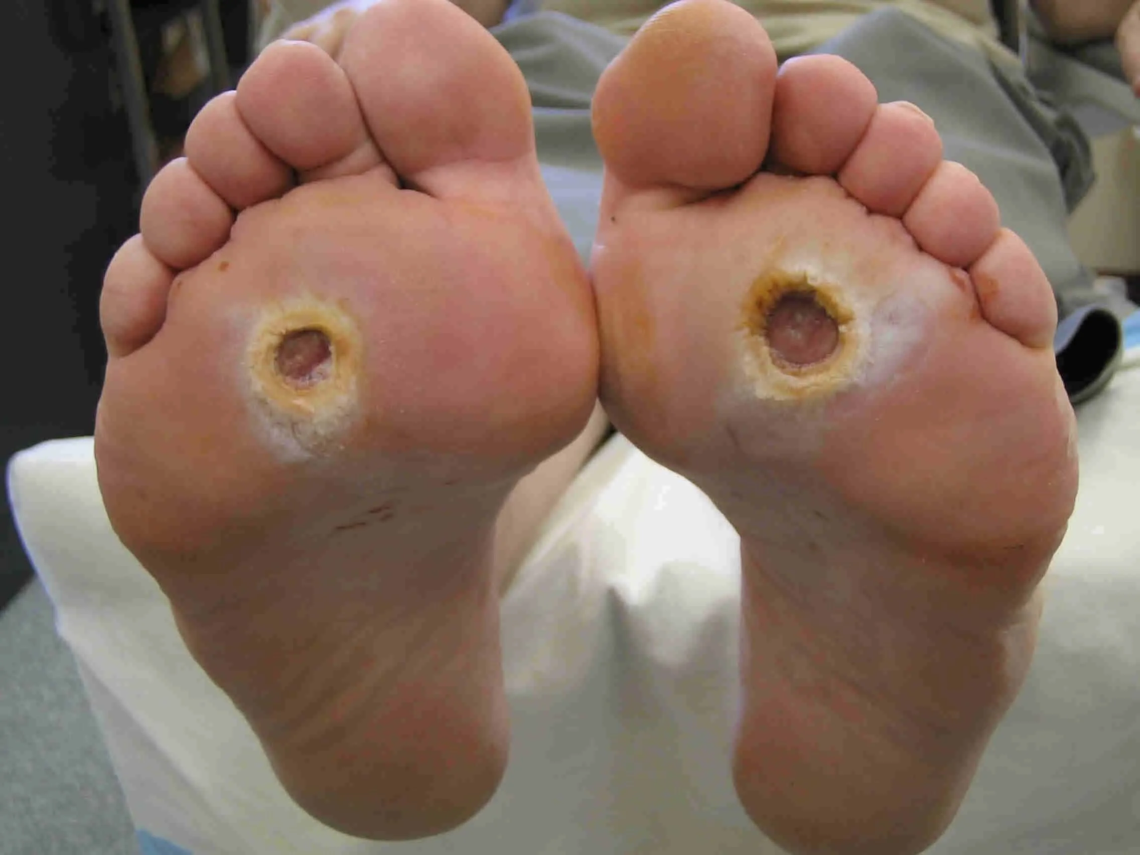 Diabetic foot ulcer requiring specialist assessment