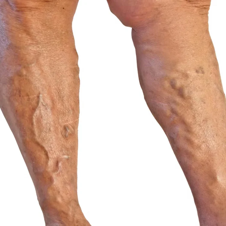 Varicose veins in the leg