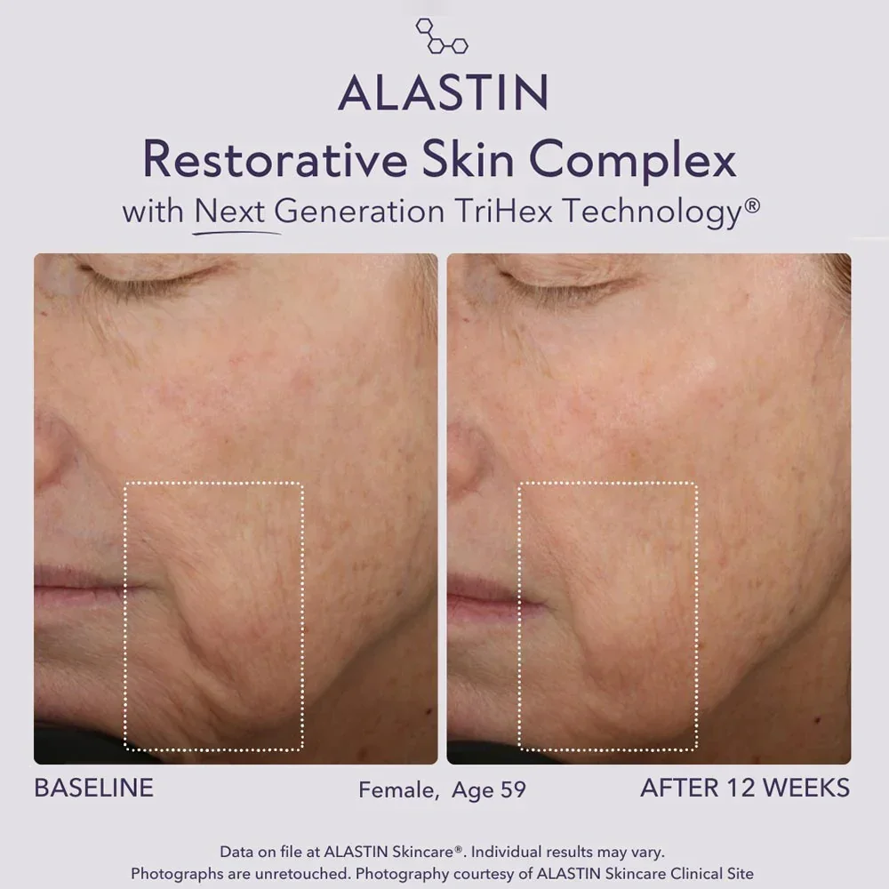 alastin-restorative-skin-complex-with-new-trihex-technology-443651_1000x.webp