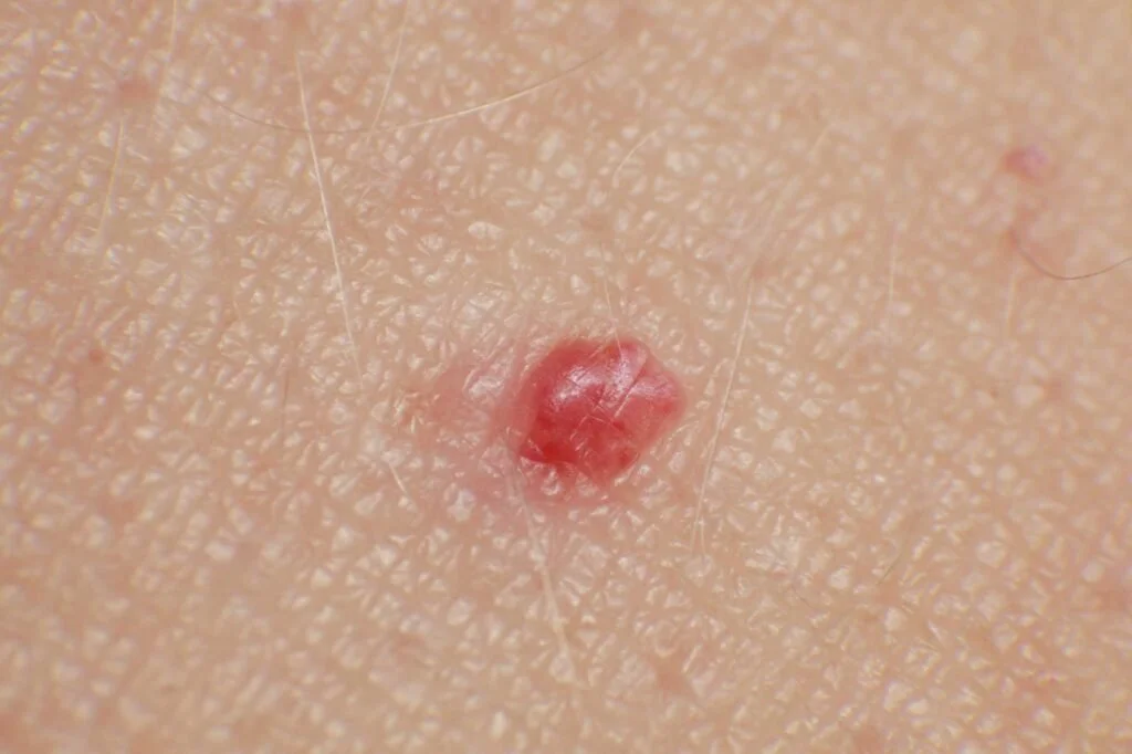 Cherry Angioma Removal