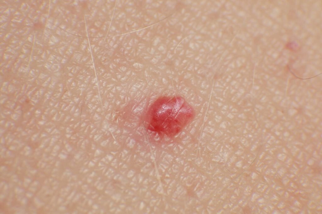 High definition close up of a cherry angioma
