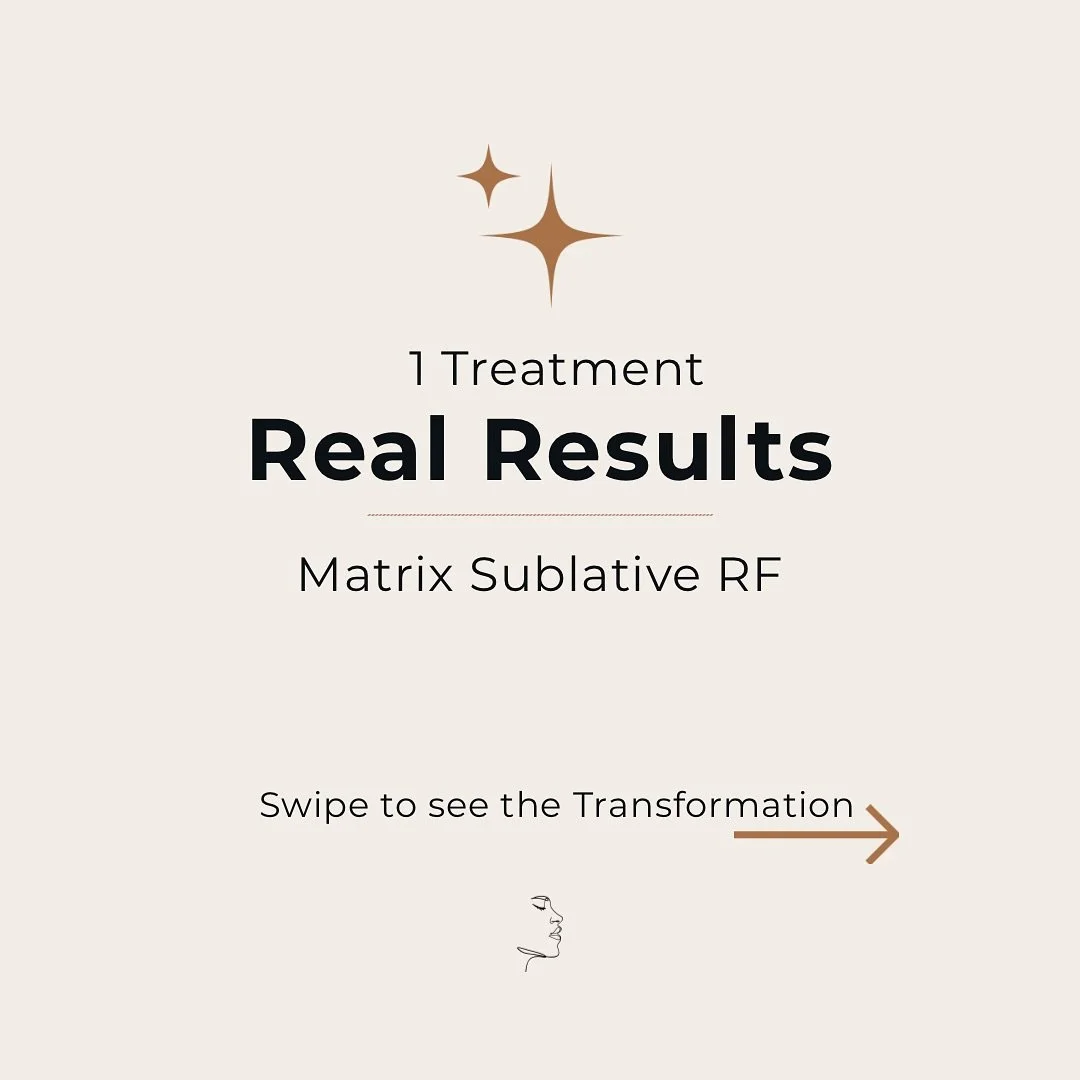 The glow-up is real. ✨
Swipe to see the incredible results achieved with just ONE Matrix Sublative RF treatment. Notice the visible improvement in skin texture, tone, and radiance.

Matrix Sublative RF works by stimulating collagen production deep wi