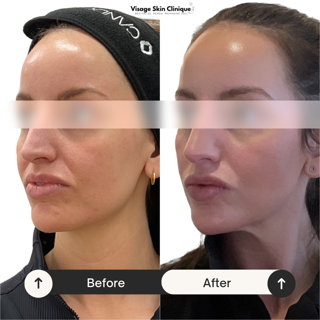 One Ultimate Duo Treatment - 2 Weeks Post