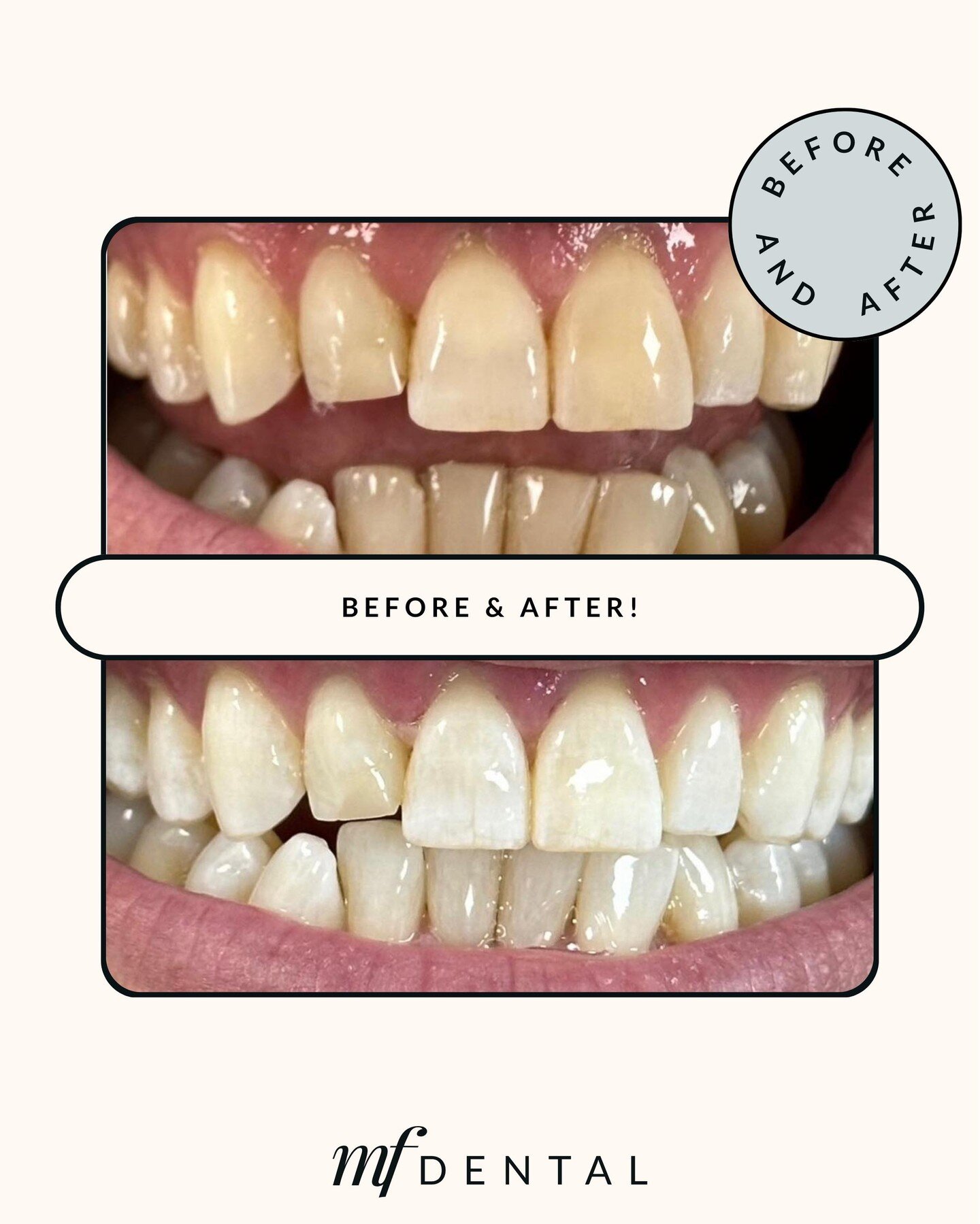 Check out the transformation we achieved for my patient using 'Zoom' Take Home Trays.🦷

For personalised advice and to determine if 'Zoom' Take Home Teeth Whitening treatment is suitable for you, schedule your free consultation with me now.

#meganf