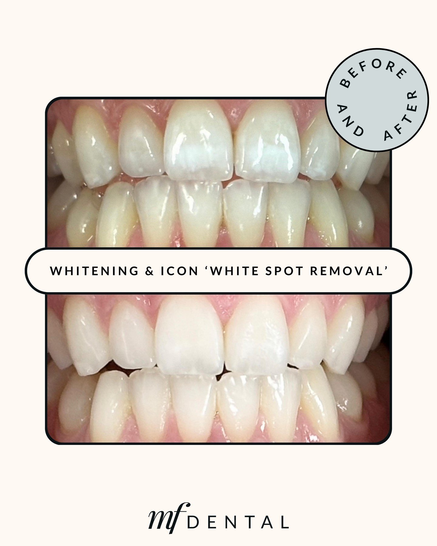 Icon White Spot Removal offers a gentle solution to enhance the look of white spots on teeth. Through the use of a specialised resin infiltrant combined with teeth whitening, this treatment seamlessly integrates the affected areas with the surroundin