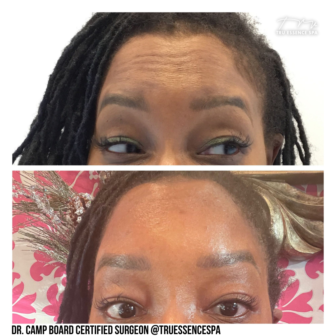 Botox.png