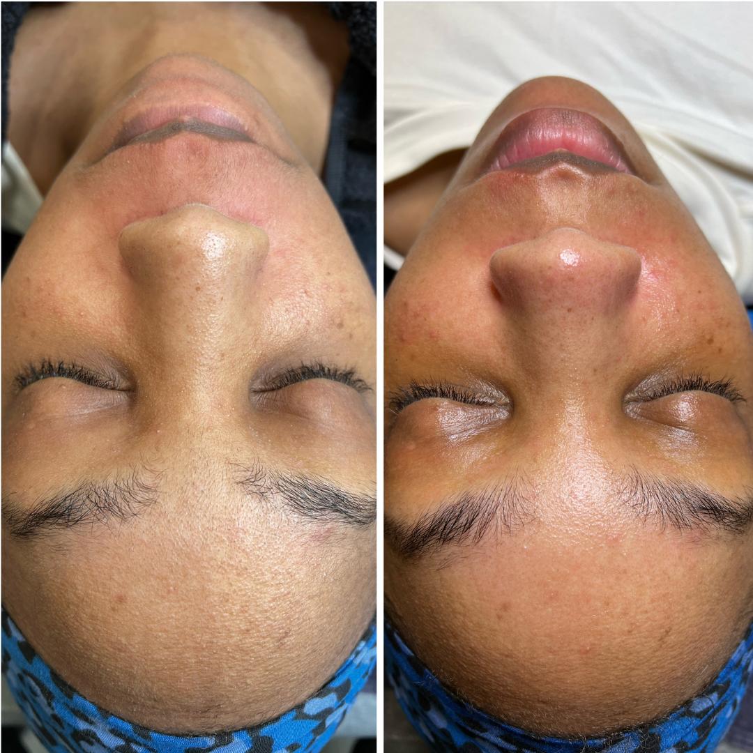 Hydrating dermaplaning facial with HA lip treatment.png