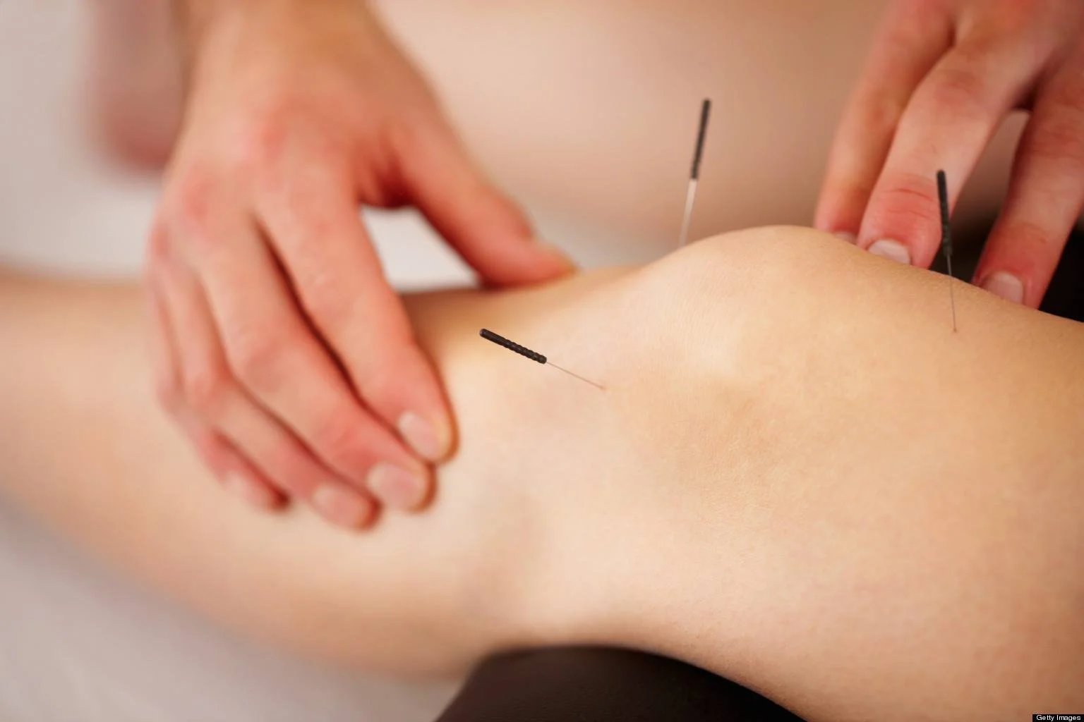 Acupuncture for Pain Relief: How It Works and When We Use It in Physiotherapy