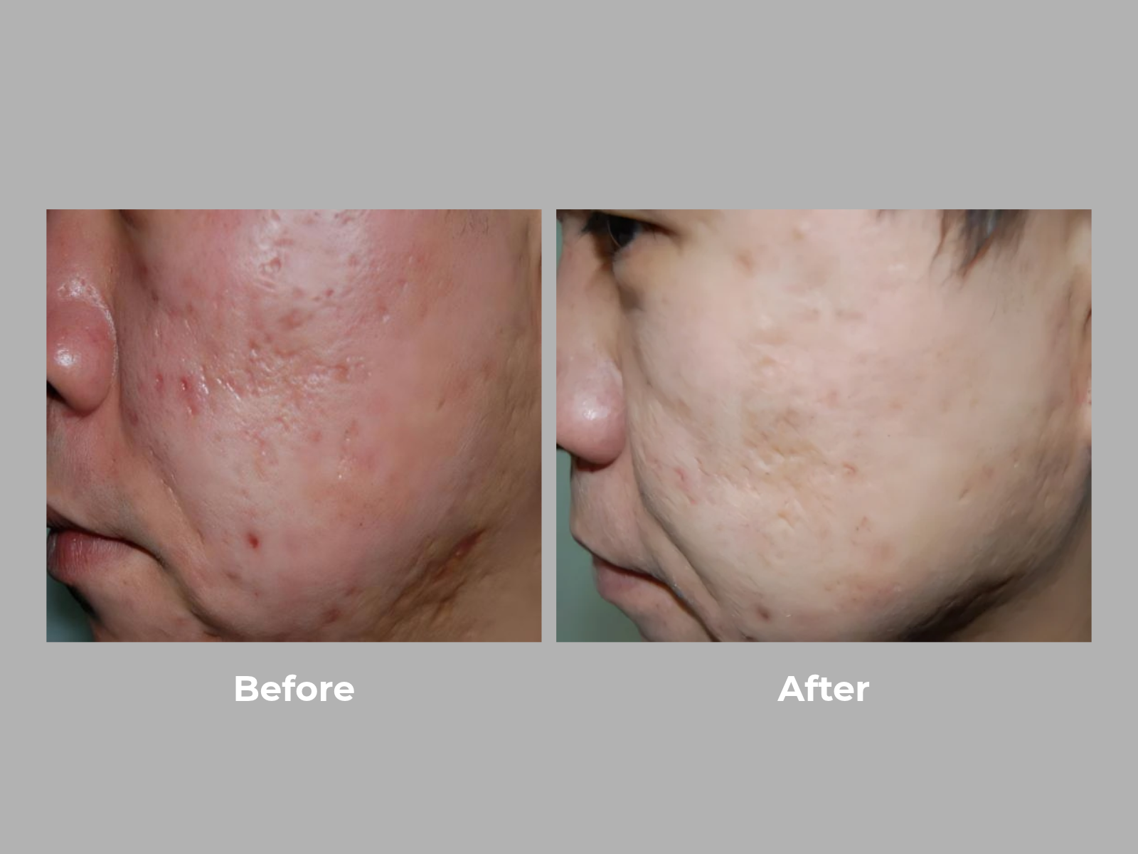 Thulera Before and After Images