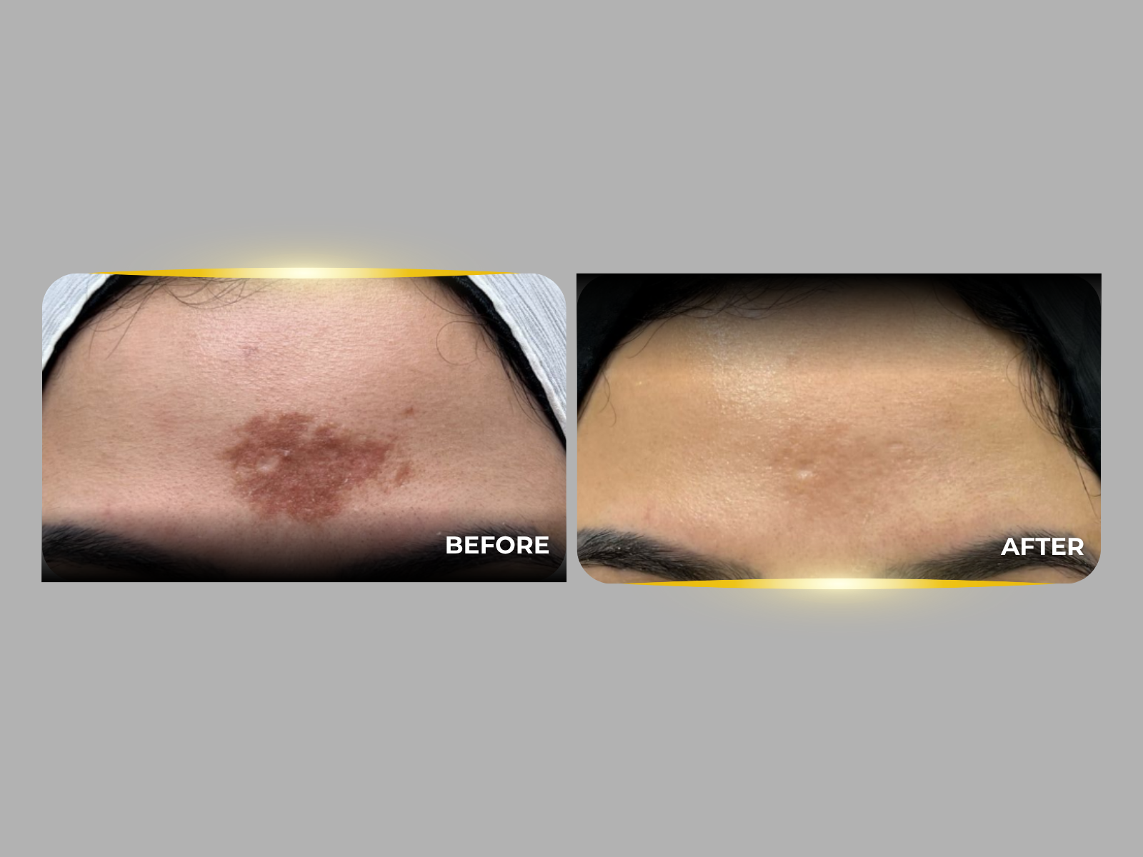 V-Tech Before and After Images