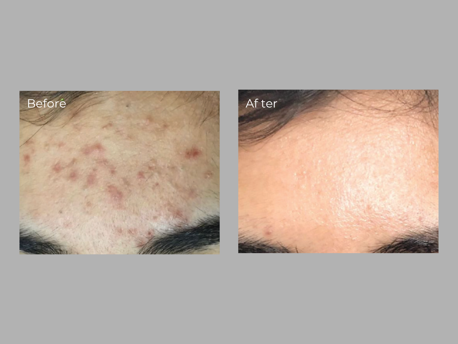 ILaser Before and After Images