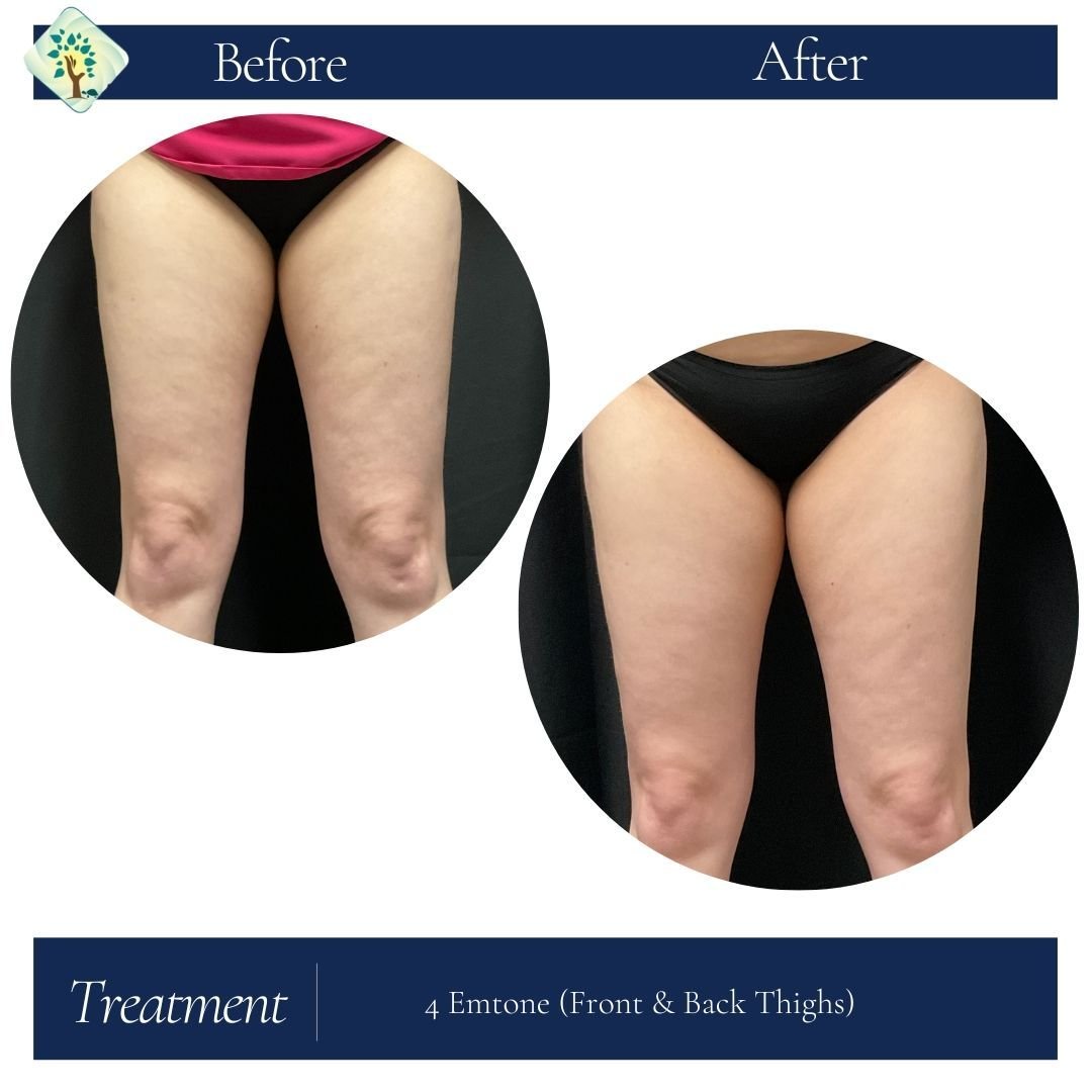 Say goodbye to cellulite with EMtone! ✨ Our clients are raving about their amazing results, and now it's your turn to experience the difference. Exclusively available at Choice Health &amp; Wellness. Don't miss out &ndash; grab yours today in our app